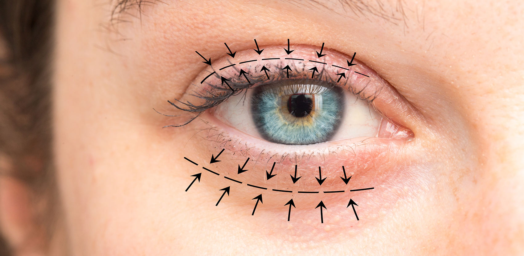 Ober- und Unterlidstraffung gleichzeitig