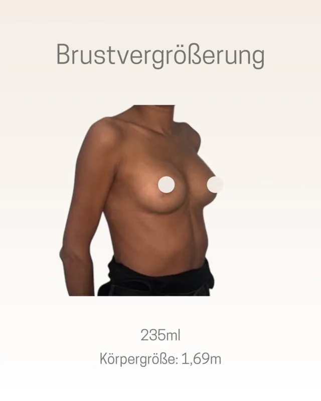 Brustvergrößerung 💫

Diese Patientin hat sich in unserer Praxis für eine Brustvergrößerung mit anatomisch geformten Implantaten entschieden. Das gewählte Volumen beträgt 235ml.

Die Implantate wurden mit der sogenannten Dual Plane-Technik eingebracht, bei der das Implantat teilweise unter dem Brustmuskel und teilweise unter dem Brustdrüsengewebe liegt.

Bei einer Körpergröße von 1,69m wurde die Auswahl von Implantatform, Volumen und Technik sorgfältig auf die körperlichen Voraussetzungen abgestimmt.

Vielen Dank für das Vertrauen! 🤍
•
•
#chirurgie #brustvergrößerung #brustop #plastischechirurgie #schönheitschirurgie #schönheit #brustoperation #nachher #ergebnis #ästhetischechirurgie #münchen